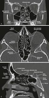 Opens into the sphenoethmoidal recess posterior ethmoidal sinuses: Nose And Sinonasal Cavities Radiology Key
