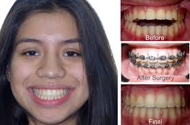 Kids and teenagers' teeth generally move if a child or teenager does not wear their elastics or maintain good oral hygiene. What Is Open Bite Symptoms Diagnosis And Treatment