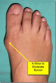 Learn how to treat bunions at home and determine if you need surgery to remove them (bunionectomy). Bunion Surgery Before And After Pictures Best Podiatrist Nyc