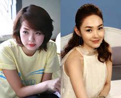 Bác sỹ sẽ tiến hành cắt bỏ một phần hay toàn bộ dạ dày và các mô xung quanh dạ dày tùy thuộc vào kích thước của khối ung thư. Nhin áº£nh Qua Khá»© Gia NhÆ° Thu Thá»§y Va Nhá»¯ng Má»¹ Nhan Nay Ä'á»«ng Pttm