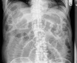 Small Bowel Obstruction Radiology Case Radiopaedia Org Bowel Obstruction Small Bowel Obstruction Obstruction