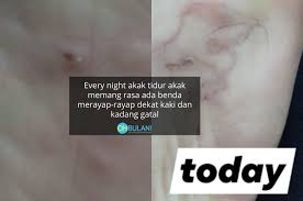 Larva cacing kerawit juga boleh menembusi kulit dan masuk ke dalam saluran darah dan seterusnya masuk ke dalam usus dan meneruskan kitar hidup yang sama. Jangkitan Cacing Di Telapak Kaki