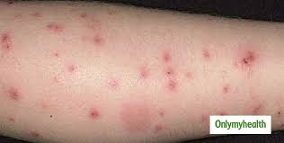 It is caused by allergenic polypeptides in mosquito saliva. Know About Skeeter Syndrome Allergic Reaction To Mosquito Bites