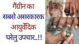 Gagarin is taken by motorcade from the airport straight to red square. à¤— à¤— à¤° à¤¨ à¤• à¤¸à¤¬à¤¸ à¤…à¤¸à¤°à¤• à¤°à¤• à¤†à¤¯ à¤° à¤µ à¤¦ à¤• à¤˜à¤° à¤² à¤‰à¤ªà¤š à¤° Gangrene Treatment In Hindi Diabetic Foot Ulcer Youtube