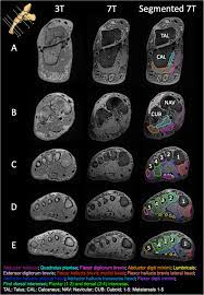 Check spelling or type a new query. New Insights Into Intrinsic Foot Muscle Morphology And Composition Using Ultra High Field 7 Tesla Magnetic Resonance Imaging Bmc Musculoskeletal Disorders Full Text