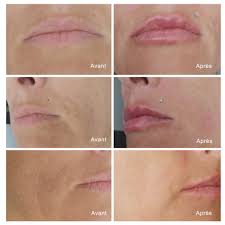 Hyaluron pen comprend des ressorts spéciaux qui facilitent l'introduction de l'ha sous la peau. Hyaluron Pen Makeup Tattoo