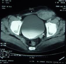 It commonly occurs in a surgical incision from a previous gynaecological or abdominal doppler examination of the soft tissues of the abdominal wall. Papillary Serous Carcinoma Arising In Abdominal Wall Endometriosis Treated With Neoadjuvant Chemotherapy And Surgery Fertility And Sterility