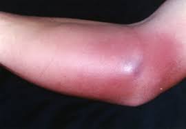 Mrsa symptoms can vary and are usually spread by contact with contaminated items or people. Mrsa Skin Infection Harvard Health