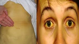 Image result for hepatitis kronis