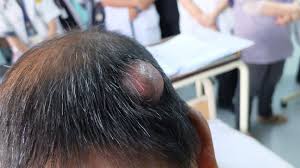 Image result for sores on the head in children
