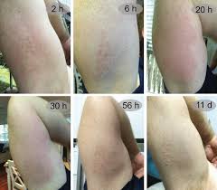 Image result for Envenomation