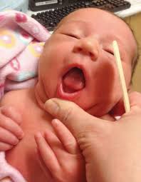 Image result for Ankyloglossia