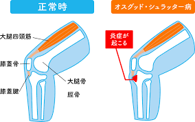 オスグッド・シュラッター病 | ミツカル接骨院
