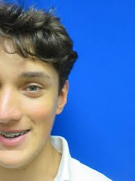 Discover the transformative effects of a browlift procedure, designed to  enhance facial aesthetics and provide a more youthful appearance for women  seeking rejuvenation. # Actual Patient # EricSchafferPlasticSurgeon # San  Antonio #Browlift #