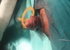 Résultat de recherche d'images pour "penis degloved"