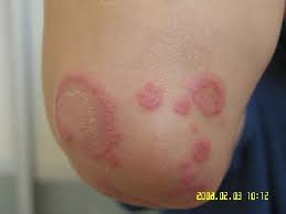 多形红斑到底会不会传染?_青岛皮肤病研究院