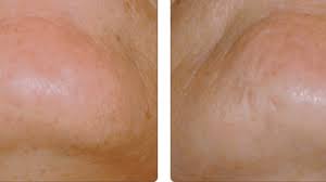 The second best epilator for face hair is the remington smooth & silky facial epilator. The Best Facial Epilator Plus Tips On How To Use It Bellatory