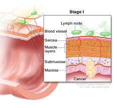 If you are diagnosed with rectal cancer, your doctors will discuss treatment options with you. Colon Cancer Hematology Oncology Associates Of Cny