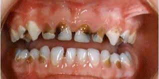 The harm of alcohol and tobacco concept. The Dentist Your Perfect Smile