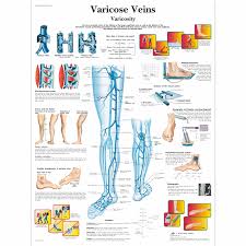 varicose veins chart