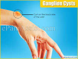 Ganglion Cysts Symptoms Causes Treatment Recurrence Body Parts Affected