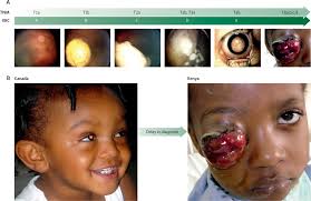Eye cancer is a term used to explain different types of tumours of eye which arise due to uncontrolled growth of healthy cells present in and around the eye. Retinoblastoma The Lancet