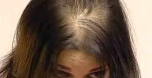 Couper ses cheveux longs quand ils deviennent ternes et cassants. Perte De Cheveux Cause Origine Et Traitements Possibles