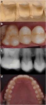 Maybe you would like to learn more about one of these? Prospective Clinical Evaluation Of 765 Partial Glass Ceramic Posterior Restorations Luted Using Photo Polymerized Resin Composite In Conjunction With Immediate Dentin Sealing Springerlink