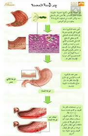 جرثومة المعده Health And Beauty Tips Health And Nutrition Health Facts