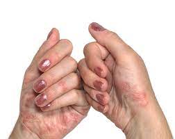 Palm Rash Symptoms Causes Treatments