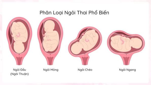 Ngôi đầu, ngôi mông và ngôi ngang có đặc điểm khác nhau khi đánh giá phương án sinh