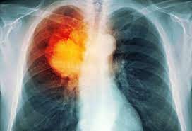 Lung cancer is the number one cause of cancer deaths in both men and women in the u.s. Lung Cancer Early Signs Symptoms Stages