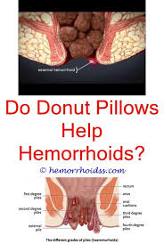 Pin On How To Treat Hemorrhoids