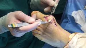 Tophaceous gout is a severe form of gout in which masses called tophi form around the joints and doctors diagnose tophaceous gout by taking a small sample from a suspected tophi and checking it. Gout Surgery Of The Foot Removing Gout Crystals Pt 2 Healthy Feet