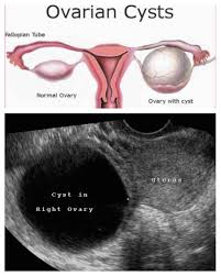 Sista ovari yang besar boleh menyebabkan. Eva Emily Clinic Alor Setar Tanda Tanda Ovarian Cyst