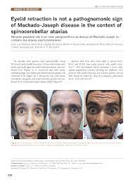 Pdf Eyelid Retraction Is Not A Pathognomonic Sign Of Machado Joseph Disease In The Context Of Spinocerebellar Ataxias