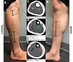 Image result for Compartment Syndrome