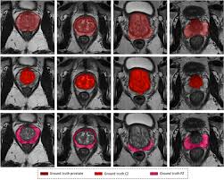 Choyke, program director, molecular imaging program, center for cancer research at the national institutes of health, bethesda. Automatic Prostate And Prostate Zones Segmentation Of Magnetic Resonance Images Using Densenet Like U Net Scientific Reports
