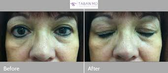 Gold weight eyelid implants can elicit a gradually progressive in ammatory response. Facial Eyelid Paralysis Bell S Palsy Photos Mehryar Ray Taban Md