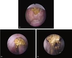 Please note that a prolapsed bladder does not actually protrude through vaginal wall, it simply presses into it, which is what causes the protrusion or bulge. grade 1 (mild): Urethra Stone An Overview Sciencedirect Topics