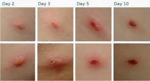 Jadi hari ini dengan penuh rasa happy saya nak share tentang cara saya hilangkan parut chicken pox yang timbul dan berlubang serta hodoh itu. Tips Rawat Parut Chicken Pox Hitam Dan Berlubang Dengan Berkesan