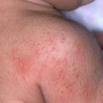 Types Of Baby Rashes Pregnant Chicken