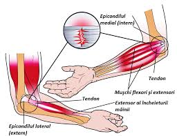 Ce este periculos hematom cerebral: Hematom Pe Tratamentul ArticulaÈiei Cotului Leziuni La Cot Cot