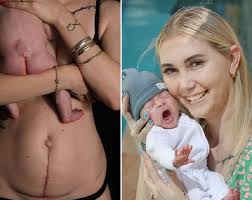 Bebê passa por cirurgia ainda dentro do útero e mãe desabafa: “meu milagre”