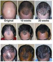 How Luxurious Locks Can Be Yours At Last Hair Loss Natural Remedy Hair Restoration Hair Loss Treatment