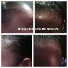 An oil worthy of charlize's coif. Emu Oil Hair Growth Progress Day One To Week 3 On Hair Line Hair Growth Oil Emu Oil Hair Growth Hair Growth Progress