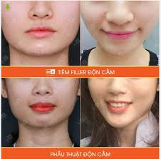 Nên lựa chọn phẫu thuật độn cằm Vline hay tiêm Filler độn cằm?