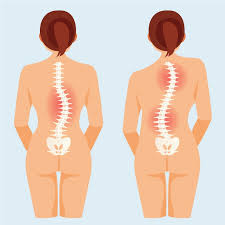 Option (a) seems to allow the. Treating Scoliosis Permanently By Scolibrace Method Coreposture