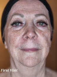 It's small business Friday and I cant contain the excitement of this  transformation. This isn't just lymphatic drainage. Take a look at my page  for more. Crystal Skin Co