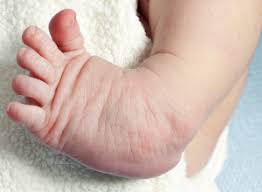 Club foot may result in developmental delays in walking, as the child may find it very difficult to walk in the beginning. Clubfoot Definition Symptoms Causes Treatment Footfiles